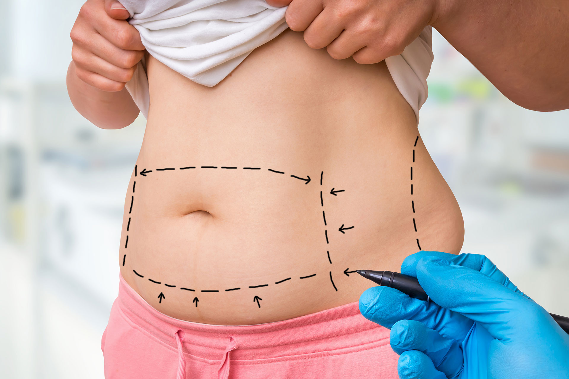 Lipofilling a Roma