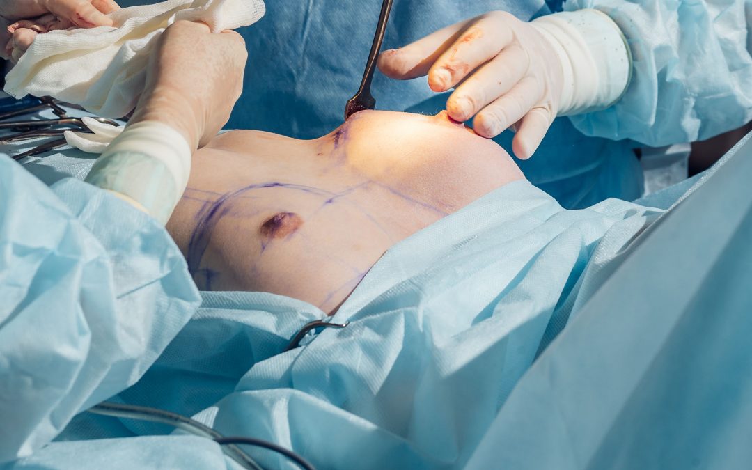 Ricostruzione Complesso Areola-Capezzolo