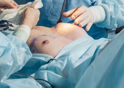 I blocchi nervosi in anestesia della mammella